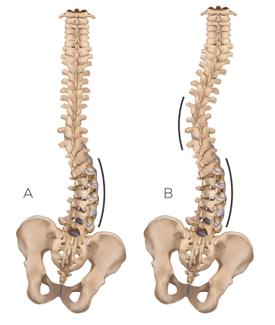 two examples of a spine curvature with and without compensatory scoliosis.