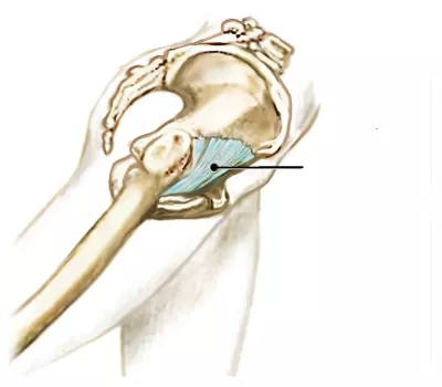 line pointing to the anterior hip capsule. 