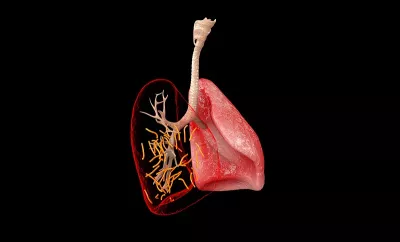 a lung illustrating scarring from pulmonary fibrosis.