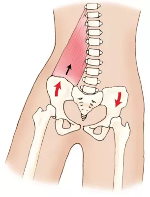 illustration of lumbosacral joint lateral flexors with the left side of the pelvis elevated.