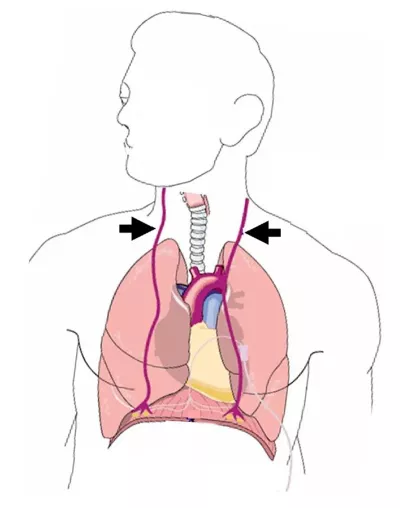 arrows point to the bilateral phrenic nerve above the lungs.