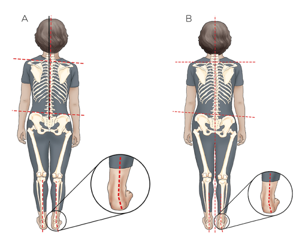 Image 4A displays a woman's pelvis tilted down to the right, while Image 4B shows a compensatory scoliotic curve.