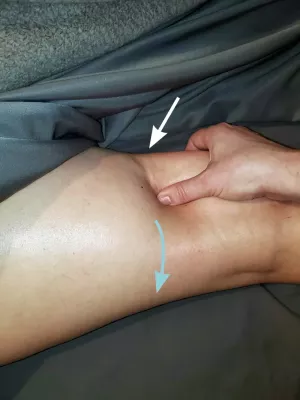 Image indicating scar restriction patterns.