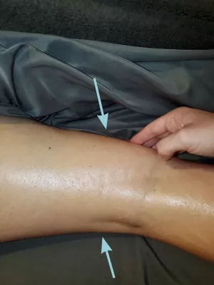 Image indicating scar restriction patterns.