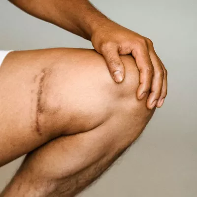 A person's leg with a scar on the inner thigh.