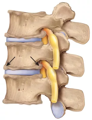 Illustration of an intervertebral foramen.