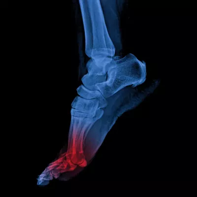 Colored x-ray of a foot with red highlighting the mtp area.
