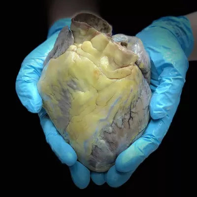 A pair of gloved hands hold a human heart.