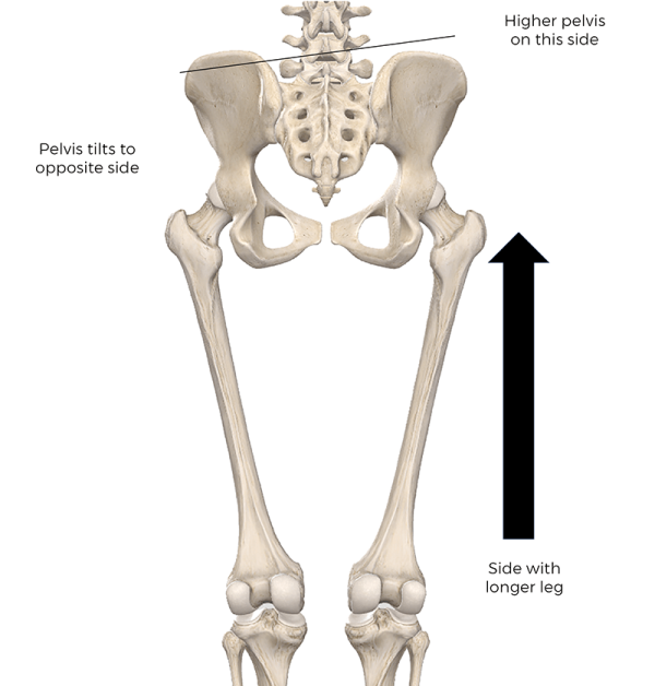 Leg-length discrepancy and SI joint dysfunction. 