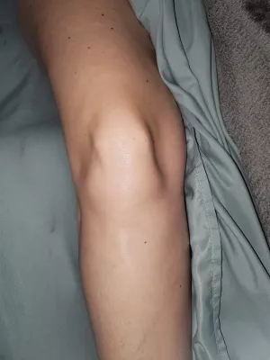 A client's knee after an ACL tear but before surgery.