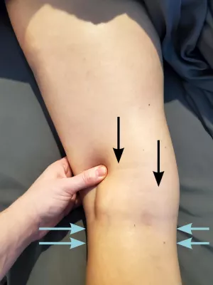 Image indicating scar restriction patterns.