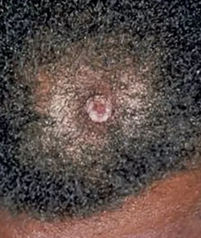 Cutaneous squamous cell carcinoma.