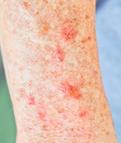 Topical chemotherapy for actinic keratosis.