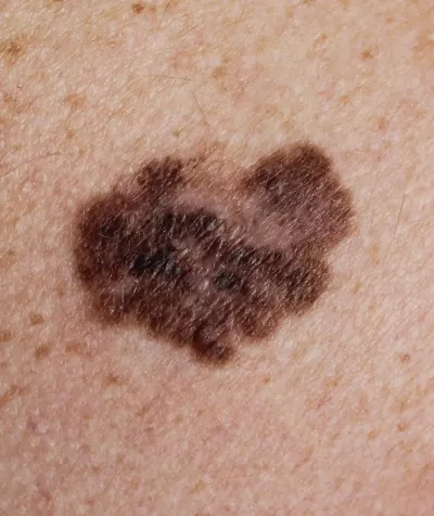 Superficial spreading melanoma.