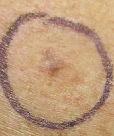 Superficial spreading melanoma, circled for biopsy.