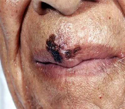 Advanced lentigo melanoma on a Black woman.