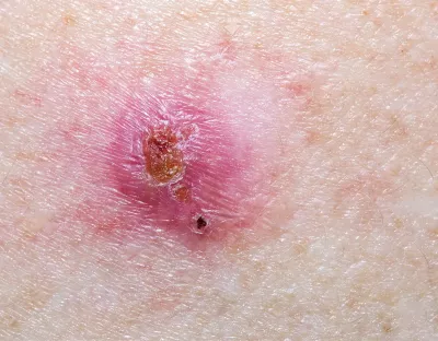 Nodular basal cell carcinoma (BCC) on a light-skinned person.