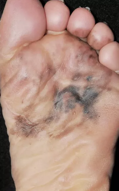 Acral lentiginous melanoma on the sole of the foot.