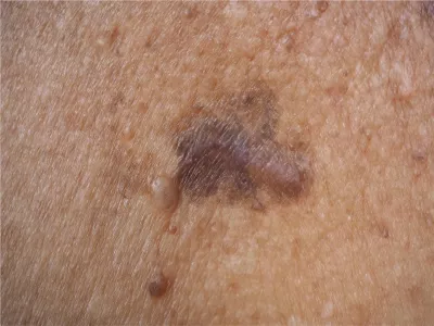 Nodular BCC on a dark-skinned person.