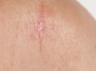 Morpheaform BCC on the back of a person's shoulder.