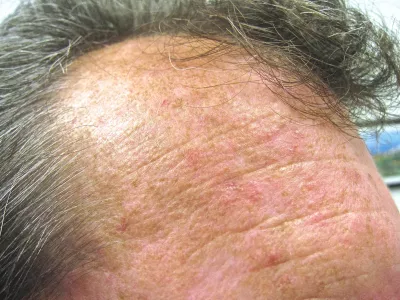 Actinic keratosis on the forehead.