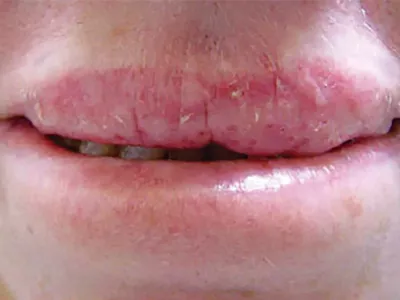 Actinic cheilitis.