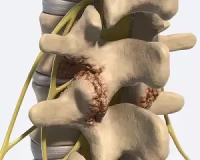 Example of degenerative change of the Z joint.