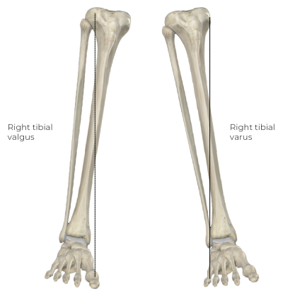 A labeled anatomical diagram of two tibia bones left and right, showing valgus and varus angulations.