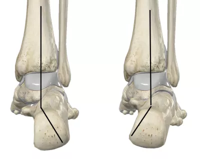 Anatomical diagram showing calcaneal valgus and calcaneal varus.