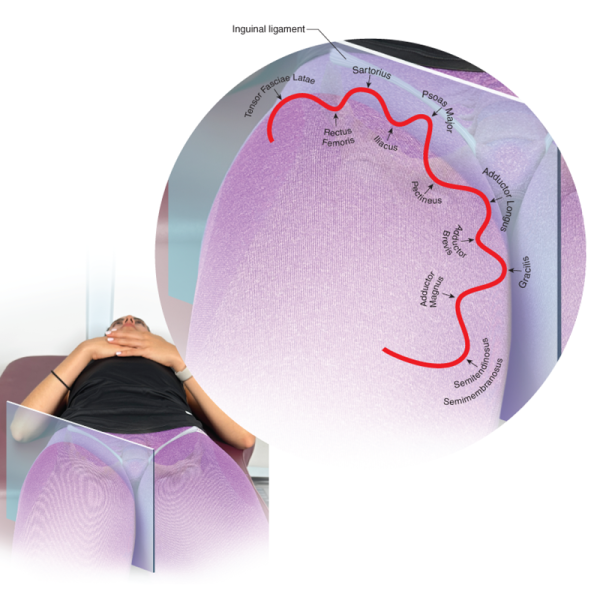 The muscles of hip joint flexion have a contour that resembles hills and valleys.