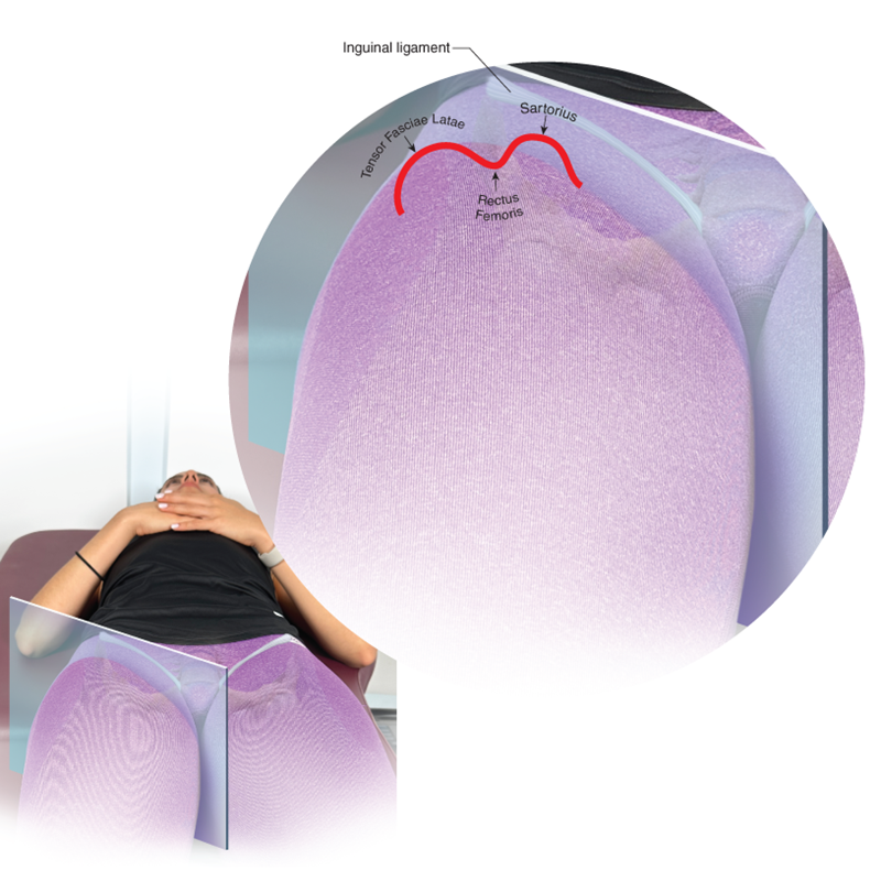  Couplets of two hills with the valley between. TFL and sartorius with the rectus femoris between.