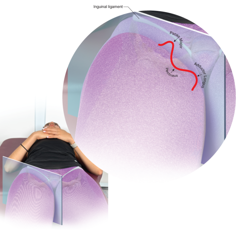 Psoas major and adductor longus with the pectineus between.