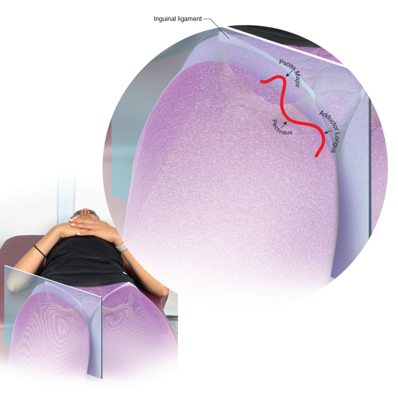 Adductor longus and gracilis with the adductor brevis between.