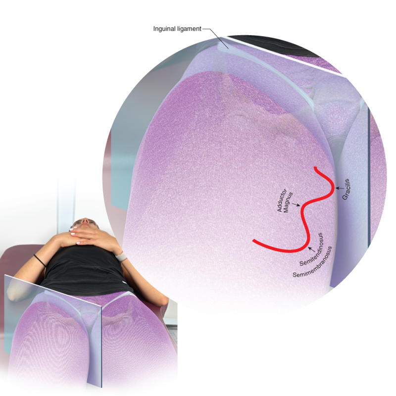 Gracilis and medial hamstrings with the adductor magnus between.