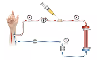 hemodialysis