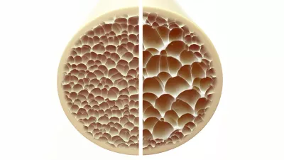 A slice of normal bone versus one with osteoporosis.