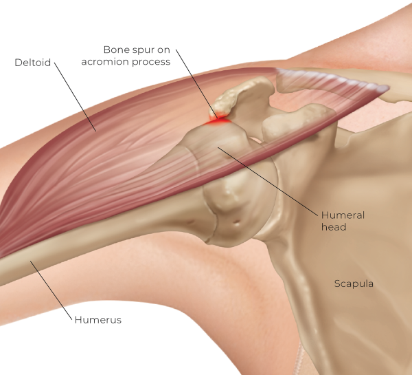 Illustration showing a bone spur on the acromion process.