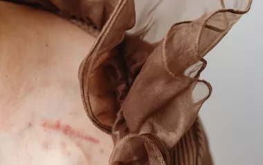 close up of a women's shoulder focused on a scar.