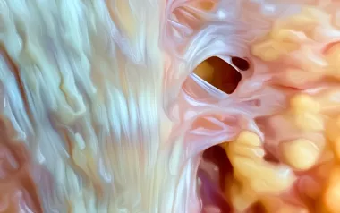 Close-up look at collagen fibers of the plantar fascia in the foot.