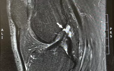 Sagittal MRI of the left knee showing ACL rupture.