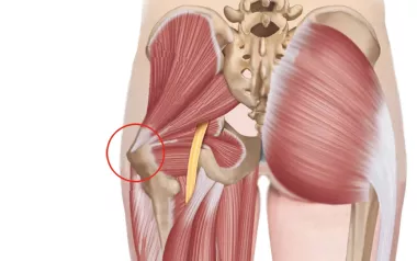 posterior view of the gluteus, showing the sciatic nerve pathway and greater trochanter.
