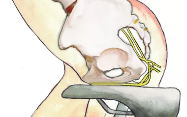 Illustration of a buttocks sitting on a slim, hard bicycle saddle can compress the pudendal nerve.