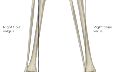 A labeled anatomical diagram of two tibia bones left and right, showing valgus and varus angulations.