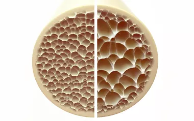 a slice of bone showing what the cellular makeup looks like with and without osteoporosis.
