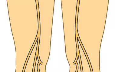 Illustration of the lower torso with the sciatic nerve and other nerves highlighted.