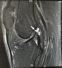 Sagittal MRI of the left knee showing ACL rupture.