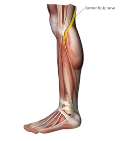 the common fibular nerve and musculature in the upper leg.
