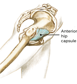 the fibrotic hip capsule.