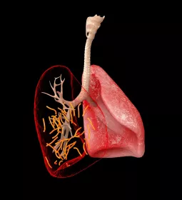 Two pink lungs, one with lines indicating scar tissue deposits.