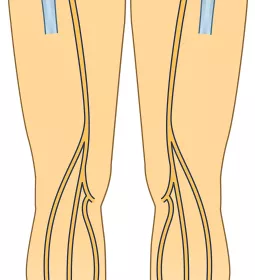 Illustration of the lower torso with the sciatic nerve and other nerves highlighted.
